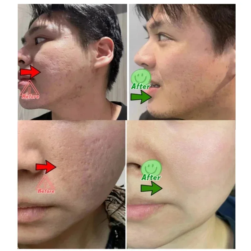 Crema per la pulizia dei pori  - Salicylic Acid Blackhead Remover recensione e prezzo