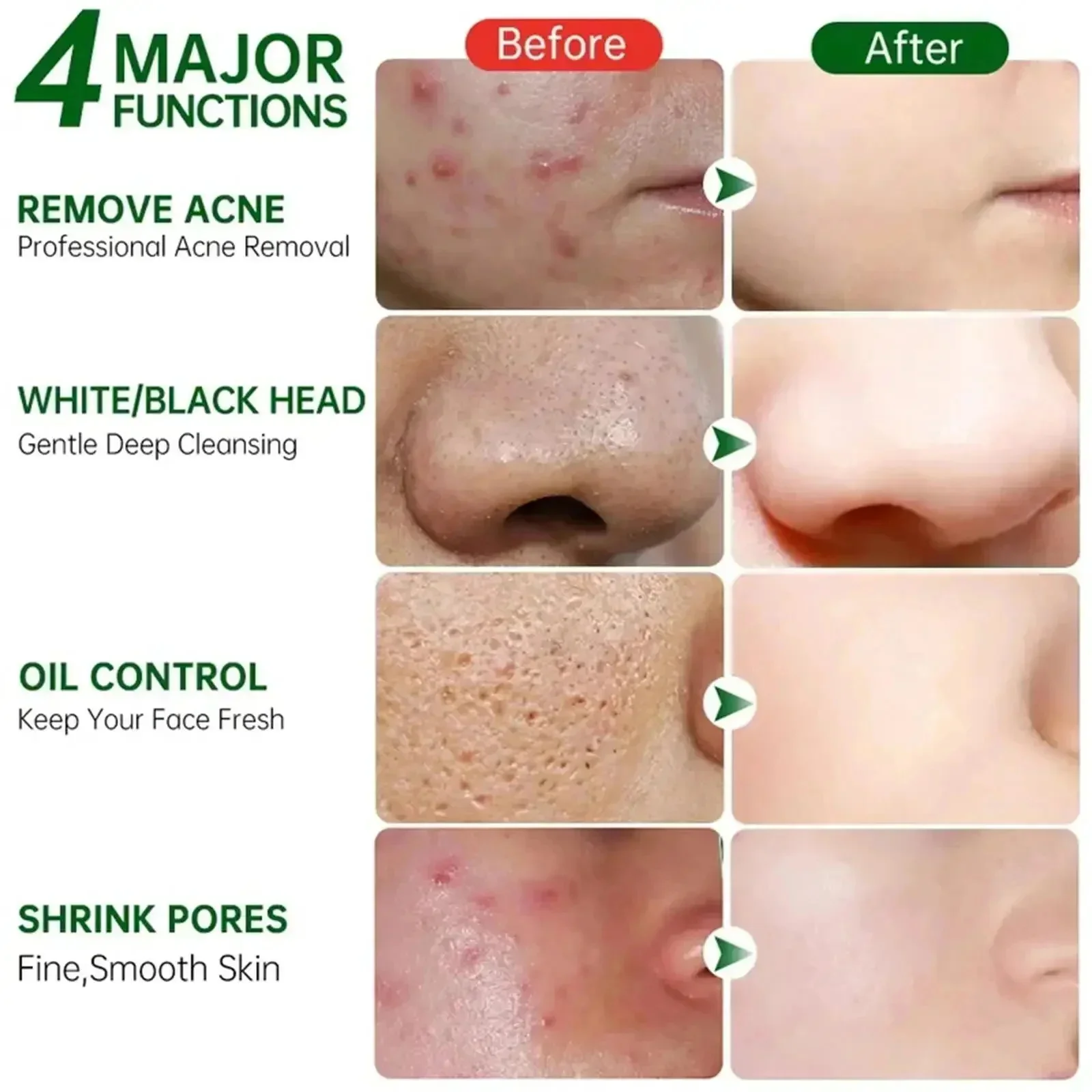 Crema per la pulizia dei pori  - Salicylic Acid Blackhead Remover recensione e prezzo