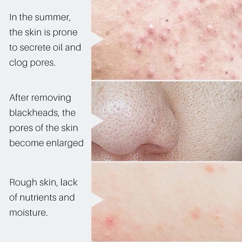 Siero all'Acido Salicilico per - Salicylic Acid Blackhead Remover recensione e prezzo